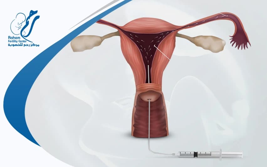 Intracervical Insemination